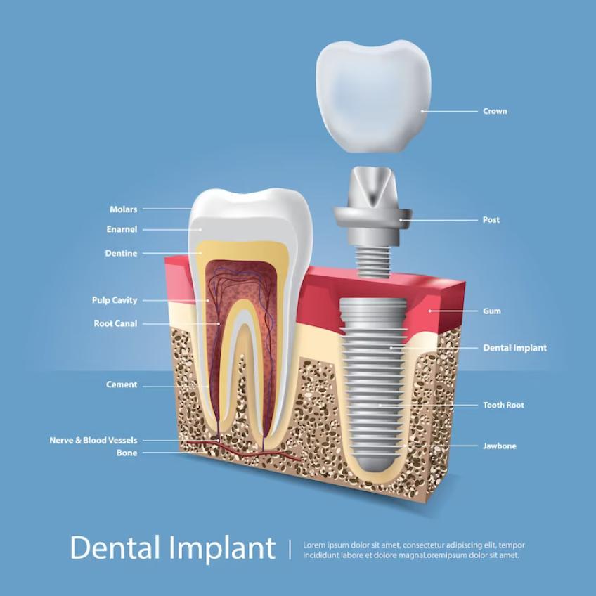 Criteria for getting endosteal dental implant