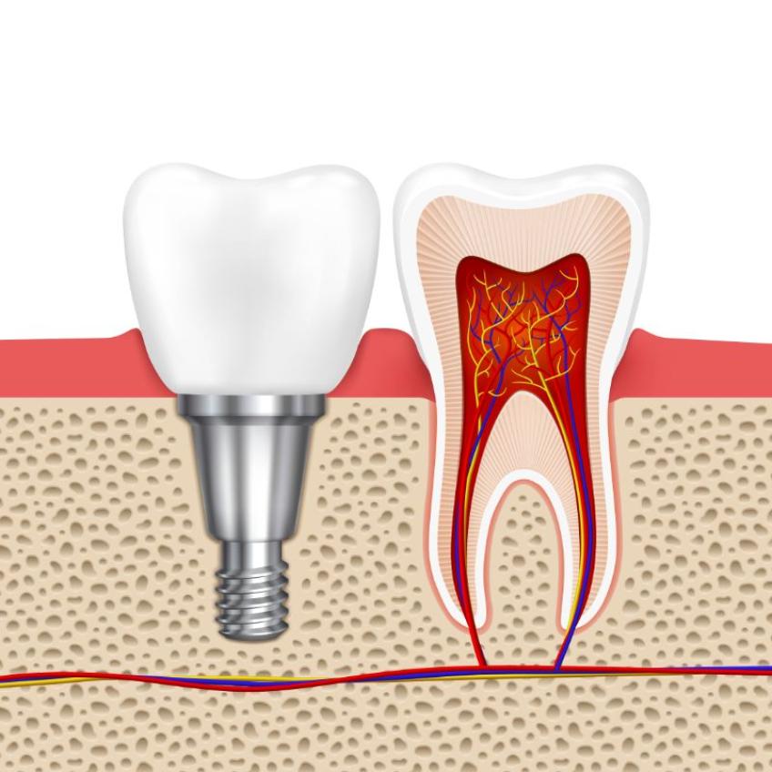 Criteria for getting endosteal dental implant