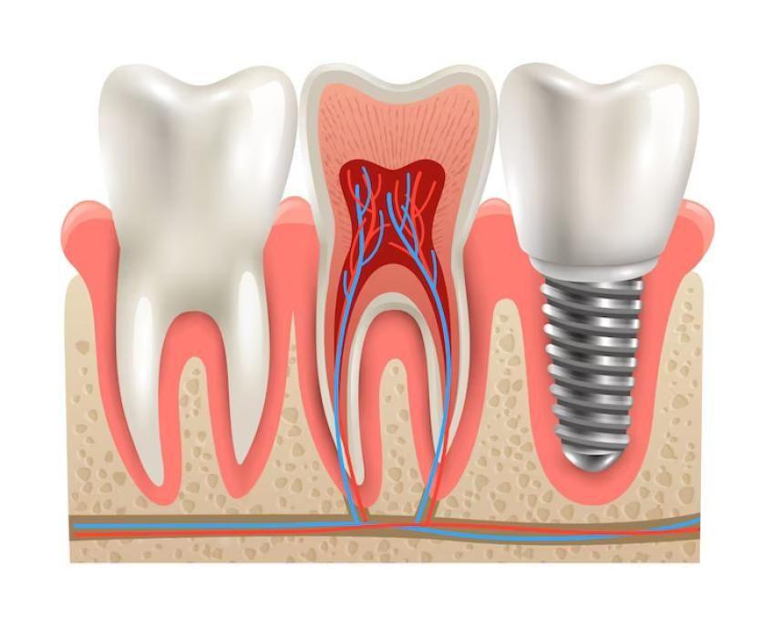 Criteria for getting endosteal dental implant