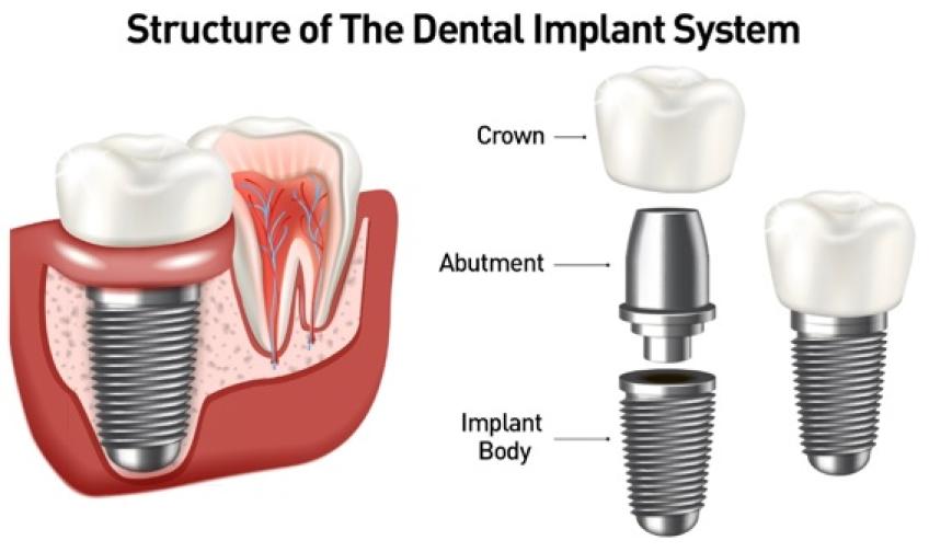 how-implants-can-prevent-jaw-deterioration