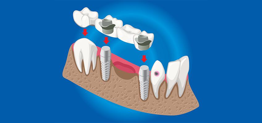 Criteria for getting endosteal dental implant