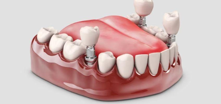 Criteria for getting endosteal dental implant