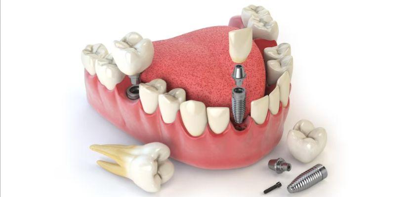 full-mouth-dental-implant-benefits