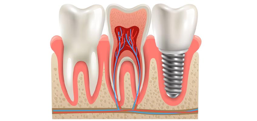 image of full-mouth dental implant cost in Bangalore