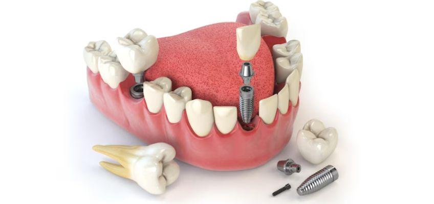 types of full-mouth dental implant