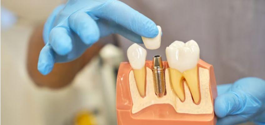 Criteria for getting endosteal dental implant