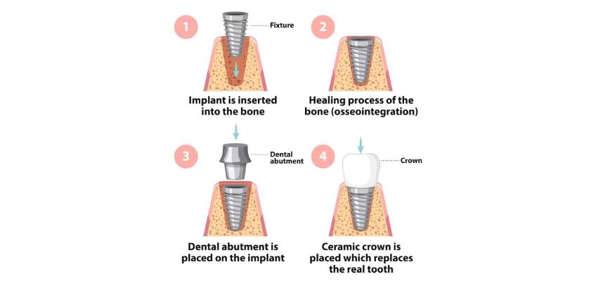 Endosteal dental implant procedures