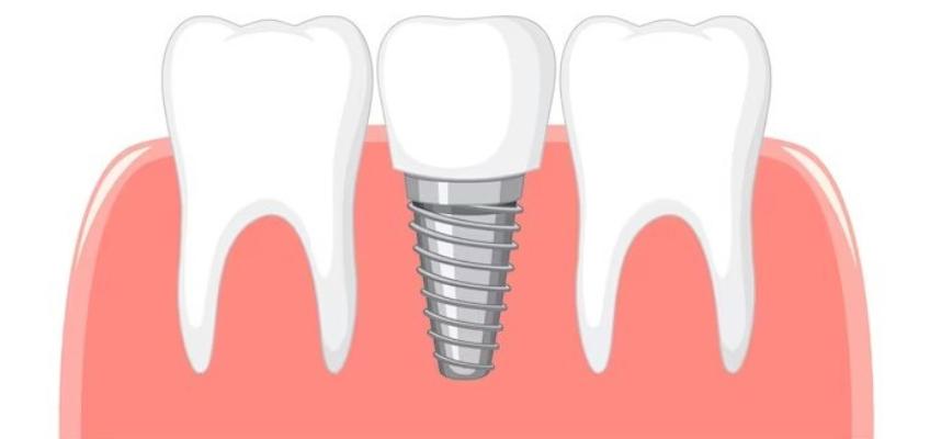image of dental implant for missing tooth