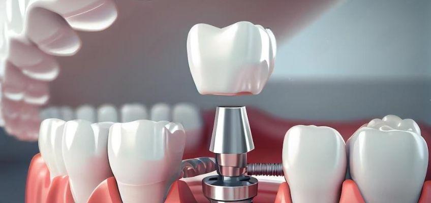 dental implants