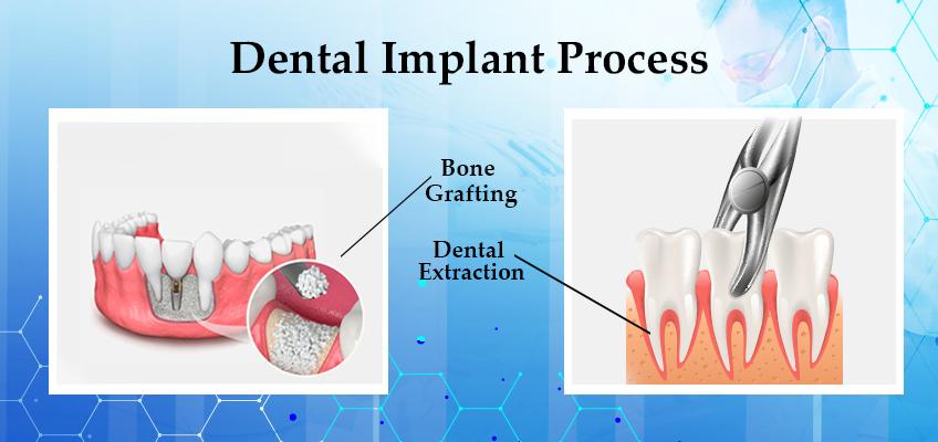 Criteria for getting endosteal dental implant