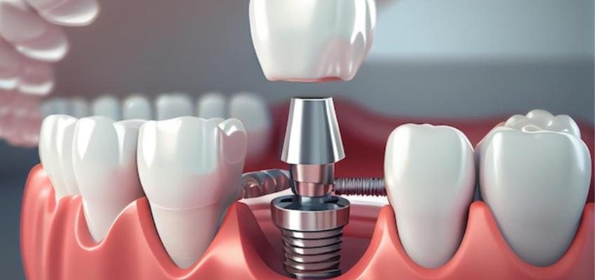 Dental Implant procedures