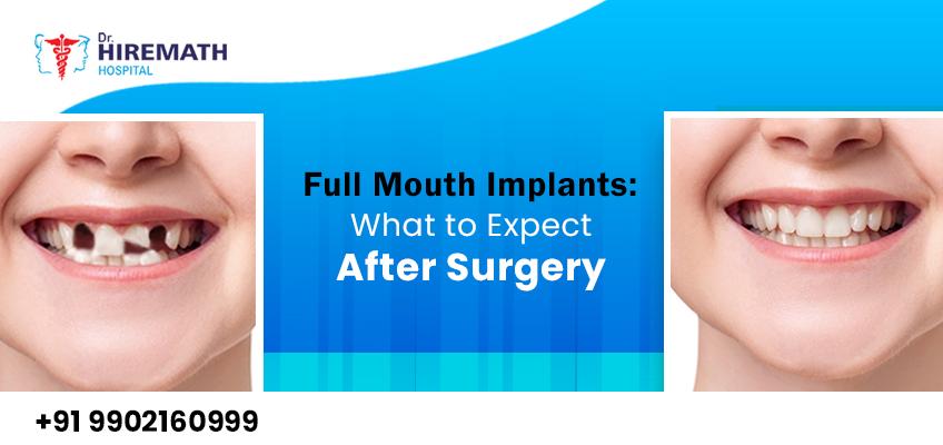 what-to-expect-after-full-mouth-implant-surgery