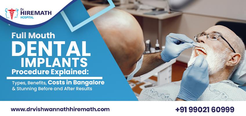 full-mouth-dental-implants-guide-bangalore