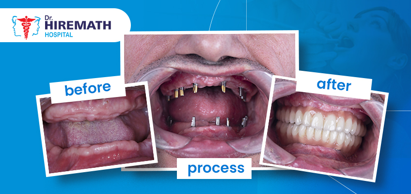 full mouth dental implants before and after