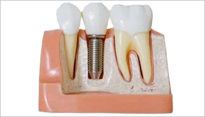 Zirconia vs.Titanium Dental Implants