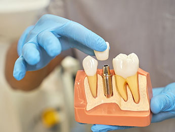 dental-implant-vs-root-canal