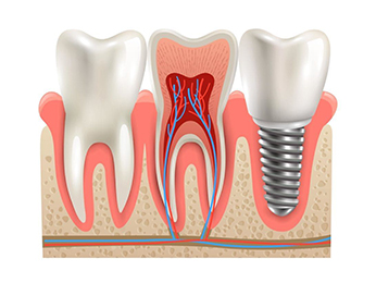 dental-implant-vs-root-canal