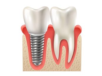 dental-implant-vs-root-canal