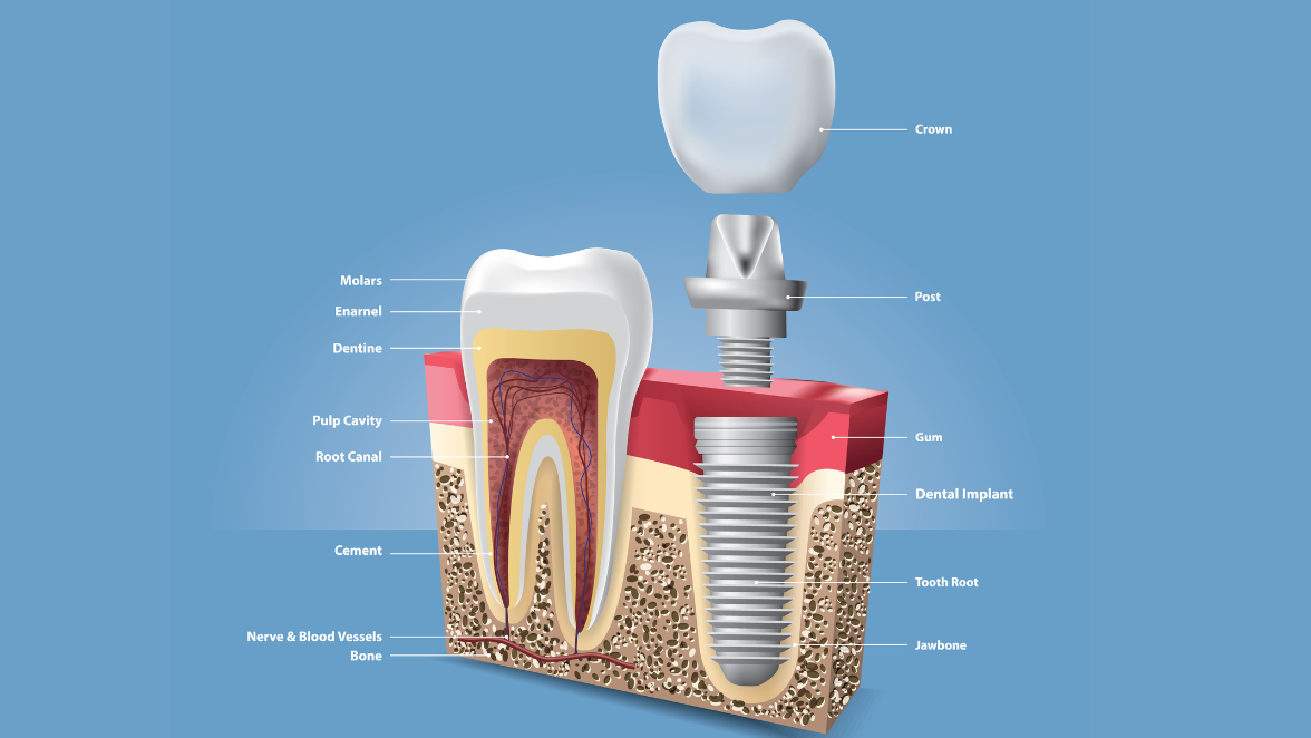 Criteria for getting endosteal dental implant