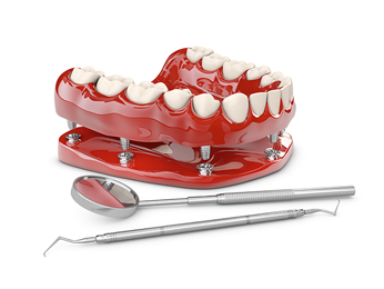 dental-implant-vs-root-canal