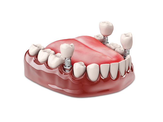 multiple-tooth-implant