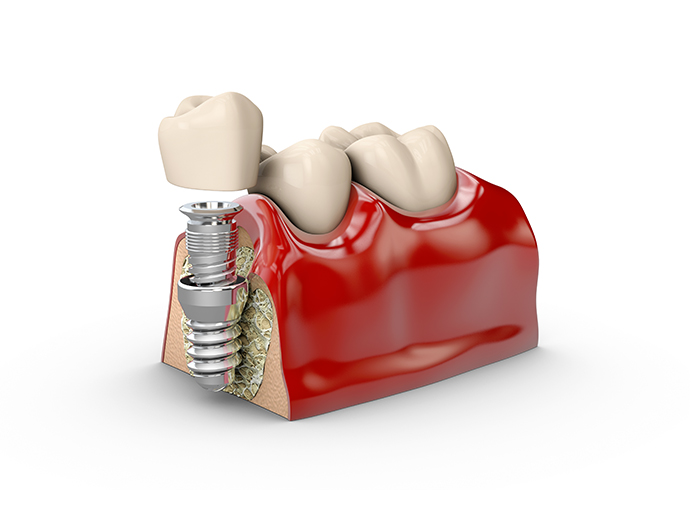 what-is-the-procedure-for-dental-implants