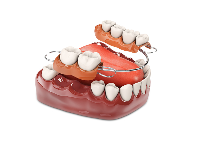 dental-implant-vs-root-canal