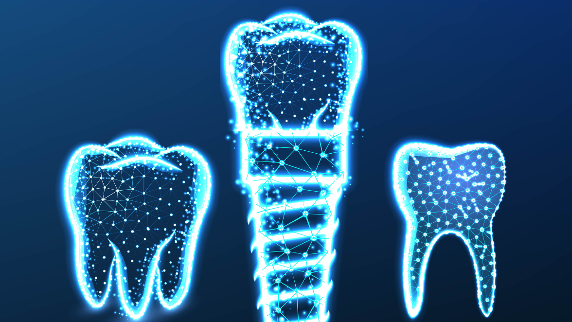 Criteria for getting endosteal dental implant