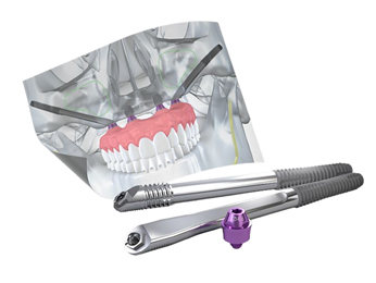 Zirconia vs.Titanium Dental Implants